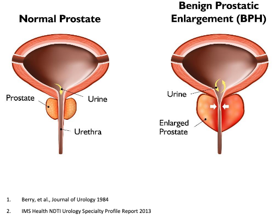 Prostate Graphic